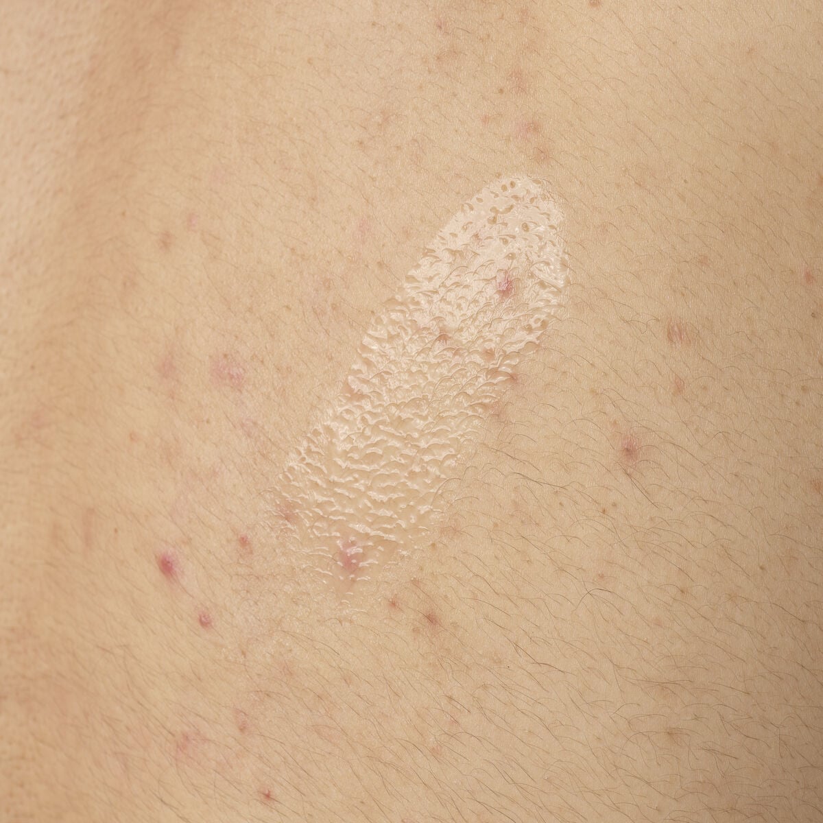 salicylic-acid-0-5-body-serum-i7 ORD-salicylic-acid-05-body-240ml-application.jpg