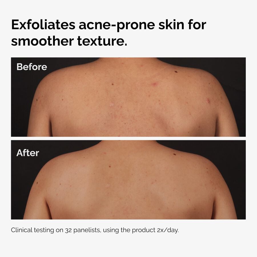 the-body-care-collection-m9 ord-salicylic-acid-body-serum-before-after-graphic-NA.jpg
